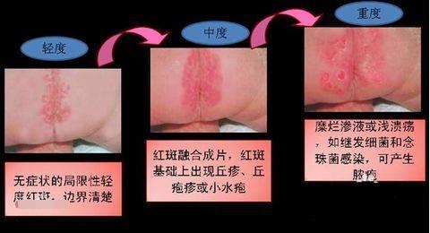 新生儿尿布疹宝宝出生的2-10周易发生,应对方法也相对简单:勤洗头,但